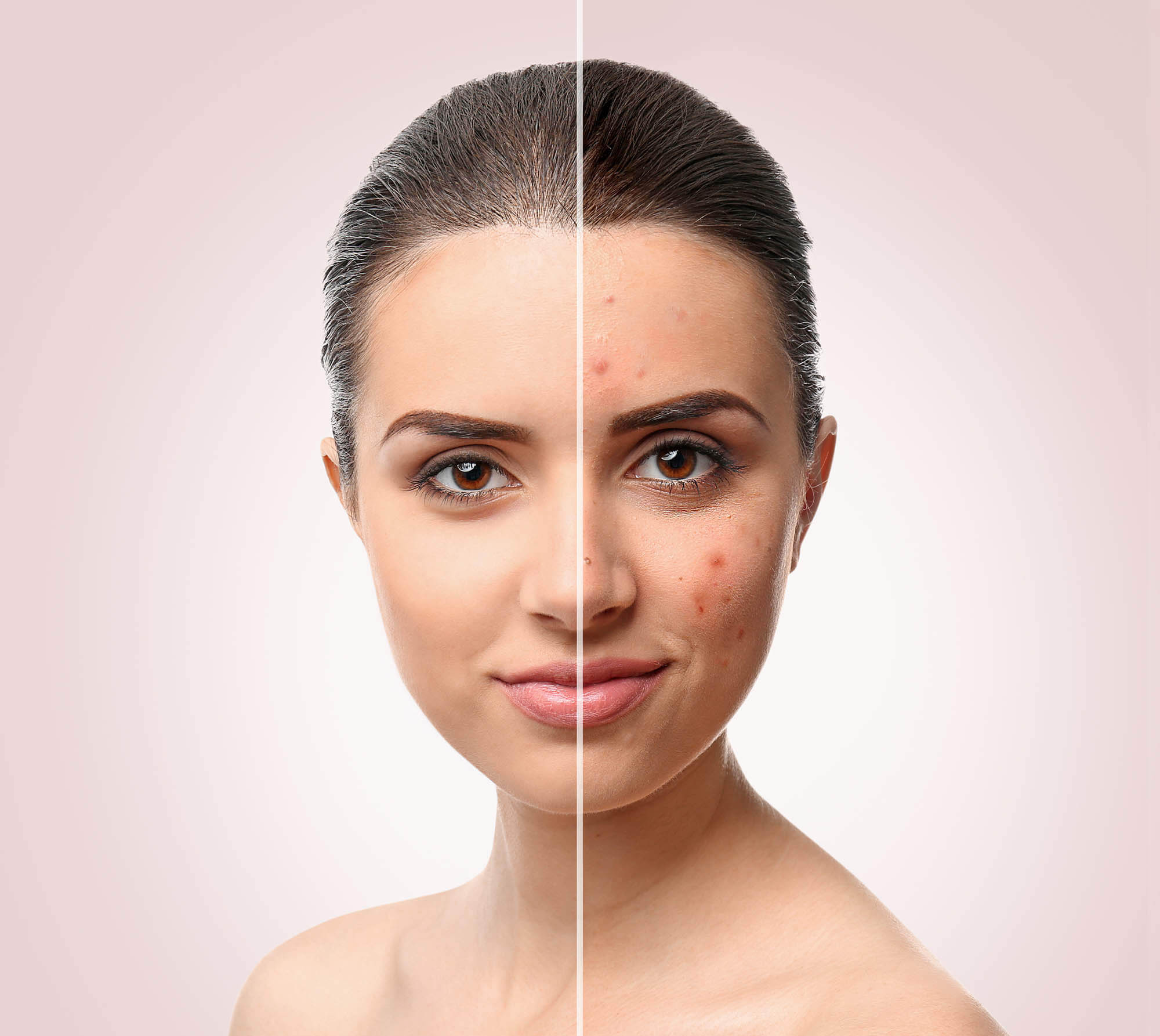 Acne Facials St Petersburg Florida